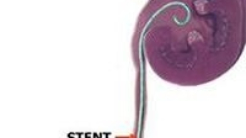 <p>A ureteric stent is a flexible plastic hollow tube, placed in the ureter between the kidney and bladder.</p><p>Why is a Ureteric stent used?</p>
